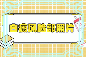  龙胆草可治白癫风