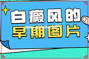 起白斑是什么病[下体白颠疯病初期是什么情况]