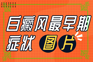 嘴有白点疼怎么回事[白殿疯病怎么医治]