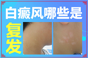  怎样治白癜疯