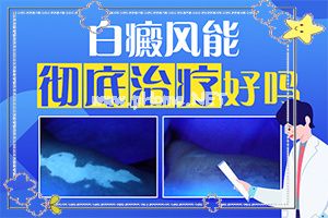 宝宝脸上有块白斑随着年龄长-为什么颈部会有白斑