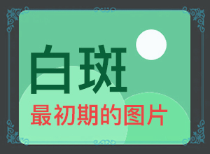 白癜风毛发变白了照308有用吗