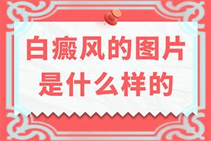头上出现白斑-[白癫疯]用什么方法