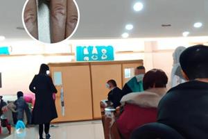 白癞癜风会传染给别人吗百度